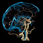 Как делают МРТ сосудов головного мозга?